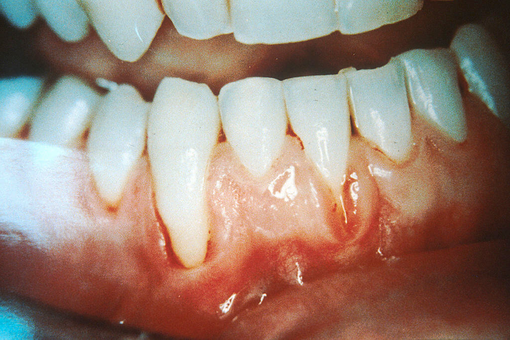 Severe gum disease increases long term complications of diabetes